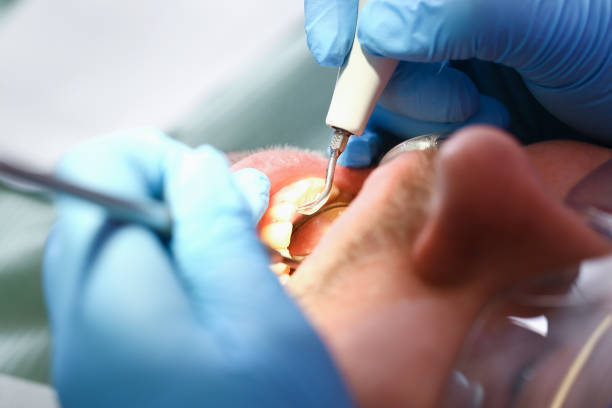 Best Dental Abscess Treatment in Red Oak, NC